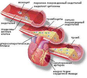От повреждения эндотелия до инфаркта (изображение с сайта www.cbio.ru)