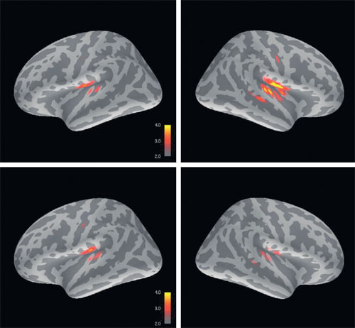 Обнаружить физиологический субстрат того, что раньше было доступно психиатрии только и исключительно в поведенческих проявлениях, значит найти потенциальную «мишень для вмешательства»: шанс на коррекцию. На снимках: МЭГ демонстрирует, что мозг ребёнка с аутизмом (внизу) реагирует на неожиданный звук иначе, чем в норме (вверху)