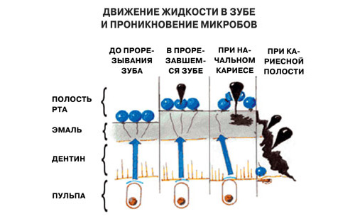 По транспортной системе дентина к поверхности эмали движется тканевая жидкость. Голубым цветом обозначены поток и капли ликвора, чёрным — попадающие на эмаль микробы