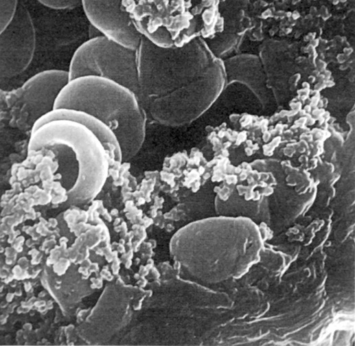 Образование красного, то есть содержащего эритроциты, тромба (электронная микроскопия, увеличение в 5700 раз). Фото B.Urbaschek: «Химия и жизнь»