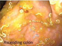 <b>Рис. 1.</b> Чтобы вылечить язвенный колит, пациент проглотил яйца <i>T. trichiura</i>, и слизистая оболочка его кишечника кишит червями