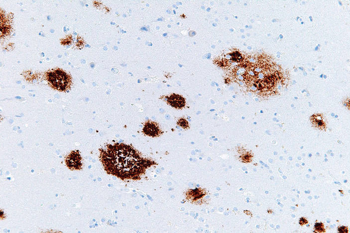 Рис. 1. Сенильные бляшки бета-амилоида