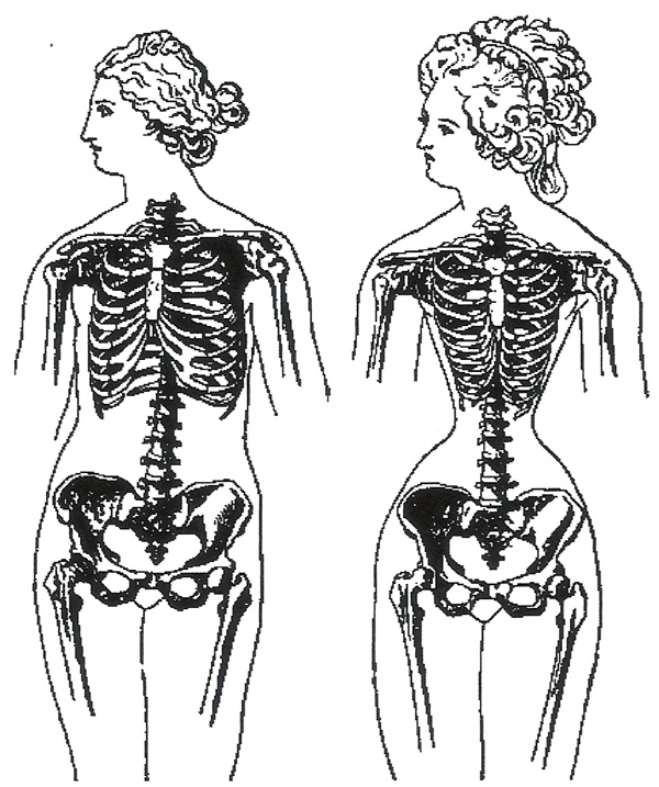 Атрофия грудной клетки вследствие длительного сдавливания корсетом (из книги немецкого антрополога Германа Плосса). И эти люди называли варварством обычай китаянок бинтовать ступни...