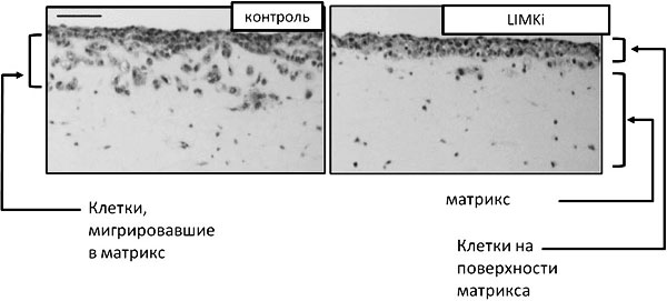 Рис. 5. Ингибирование LIM-киназы подавляет инвазию клеток модельной опухоли. Рисунок из обсуждаемой статьи в The journal of cell biology, с изменениями