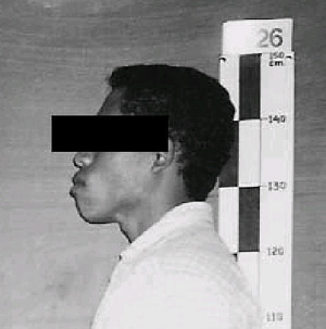 В большинстве учебников по антропологии можно прочесть, что подбородочный выступ — одна из самых характерных отличительных черт Homo sapiens, по которой челюсть современного человека всегда можно отличить от челюсти неандертальца или питекантропа. Однако среди пигмеев-рампасаса с острова Флорес весьма часто встречаются индивидуумы, лишенные подбородочного выступа. Фото из статьи в PNAS