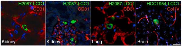 Единичные латентные раковые клетки клетки в капиллярах и паренхиме различных органов