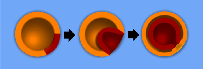 Рис. 2. Инвагинационная гаструляция, характерная для нормального развития актинии нематостеллы