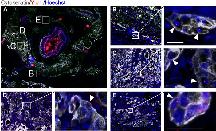 Рис. 5. Гибридные клетки в опухоли человека
