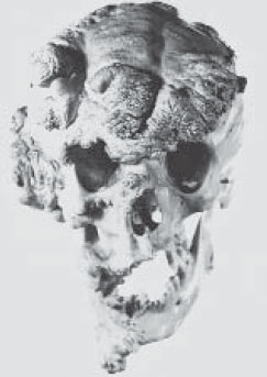 <p>Синдром Протея. Джозеф Меррик (1862–1890).</p>