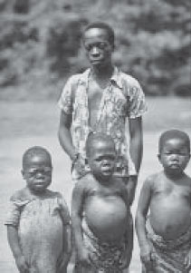 Микседематозные кретины приблизительно в 20-летнем возрасте и здоровый мужчина. Демократическая Республика Конго (Заир), ок. 1968 г.