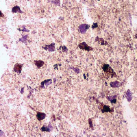 При паркинсонизме происходит дегенерация нейронов черного вещества, выделяющих дофамин и регулирующих таким образом работу базальных ганглиев (© 2000 WebMD, Inc.; изображение с сайта my.webmd.com)