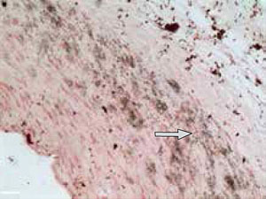 Рис. 2. Обширные участки кальцификации в стенке аорты («Химия и жизнь» №6, 2016)
