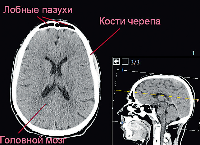Одно из изображений при КТ головного мозга