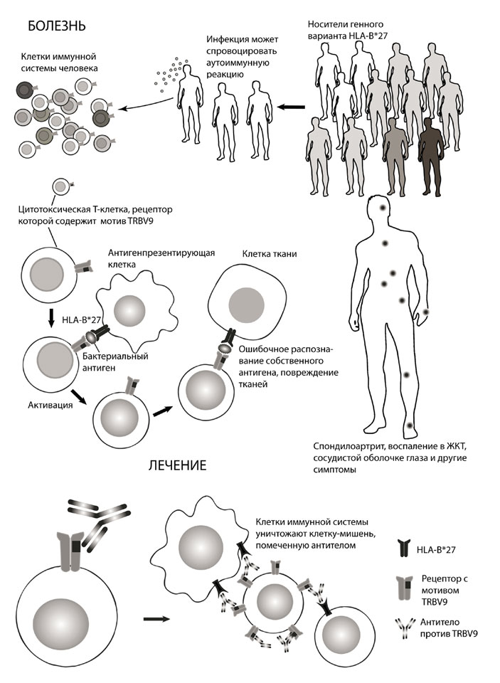 Развитию болезни Бехтерева способствуют генный вариант HLA-B*27 и факторы, провоцирующие воспаление, например бактериальная инфекция