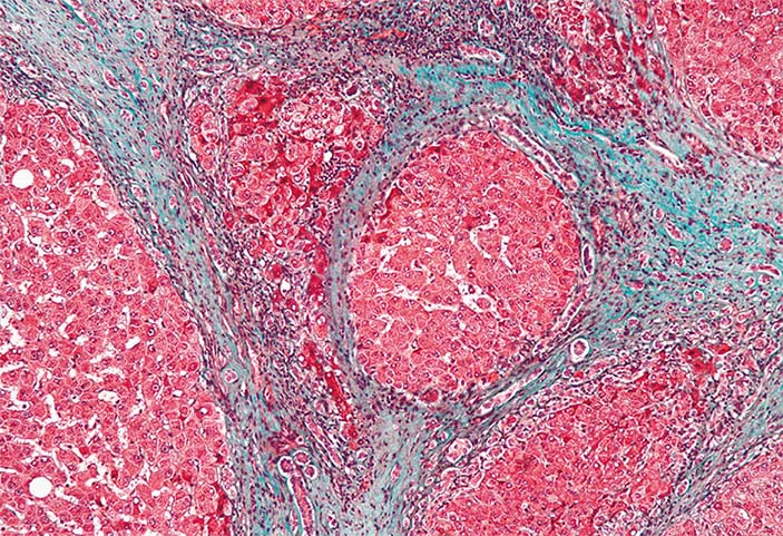 На микрофотографии образца печени больного циррозом видна узловатая структура из островков печеночной ткани