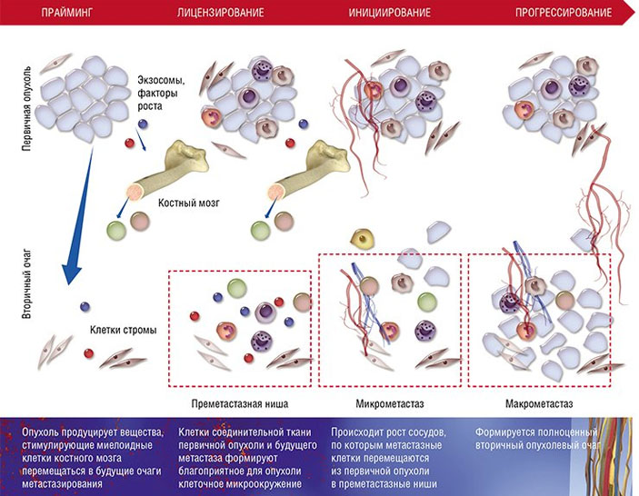 В формировании метастазов выделяют несколько стадий («Наука из первых рук» № 1(77), 2018)