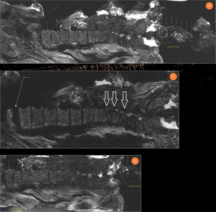МР-томограммы мумии «Алтайской принцессы» («Наука из первых рук» №3/4(57/58), 2014)