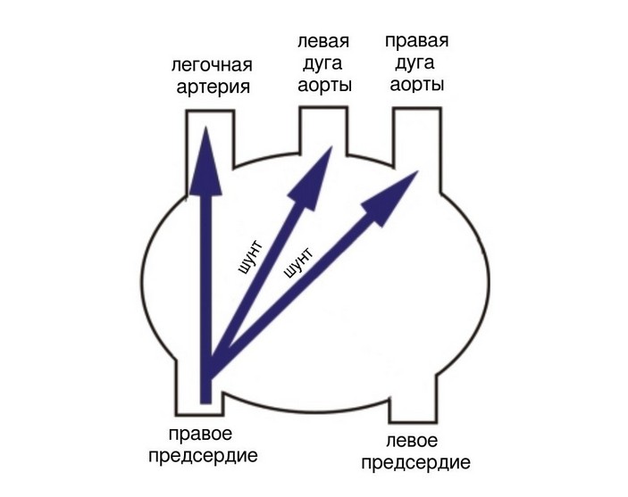 Право-левый шунт