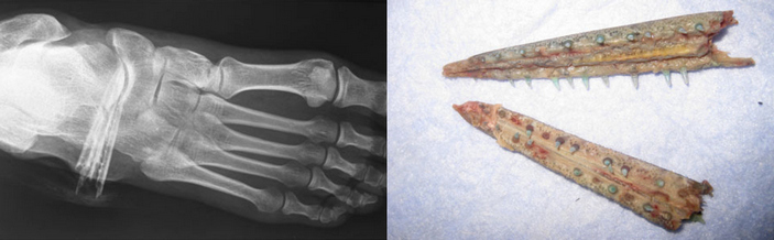 Застрявшая в ноге челюсть саргана