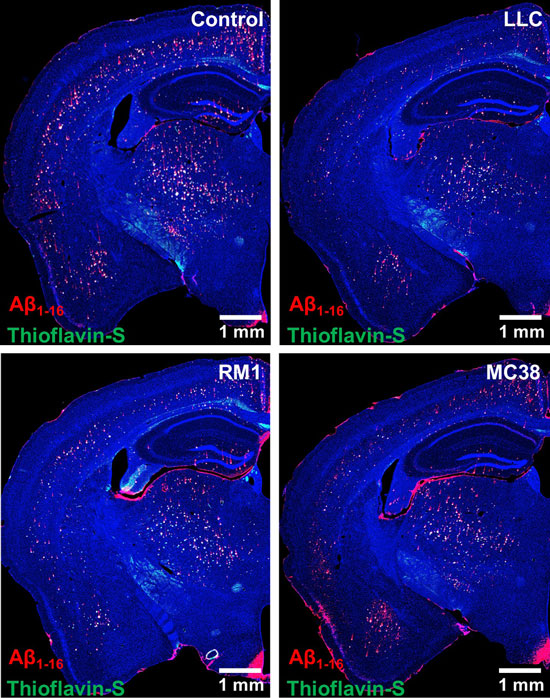 Рис. 1. Микрофотографии мозга мышей из контрольной группой и с тремя видами рака; амилоидные бляшки помечены амилоид-специфичными флуоресцентными красителями