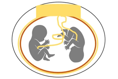 Однояйцевые близнецы