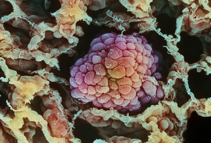 Электронная микрофотография раковой опухоли легкого на ранней стадии роста