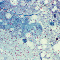 Клещевые риккетсиозы — близкие родственники сыпного тифа