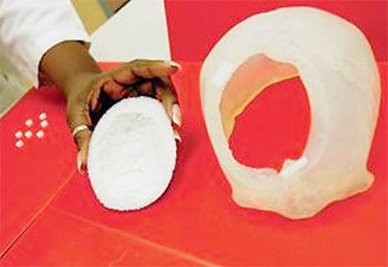 Модель черепной коробки после трепанации, изготовленная на 3D-принтере, так же как и «заплатка», которой закроют отверстие, даёт возможность хирургам спланировать операцию и провести тренировку.