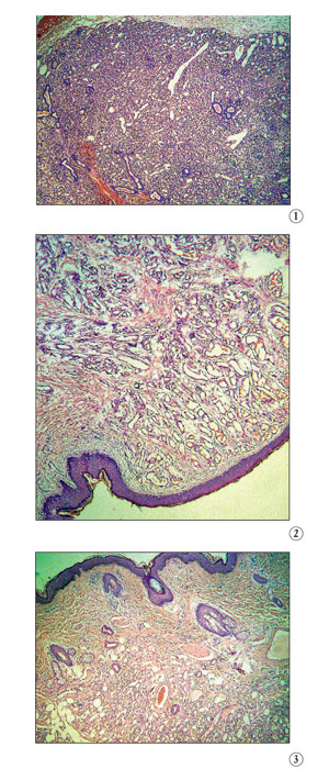 Микрофотографии иллюстрируют поведение «неопухоли-гемангиомы» от её появления до исчезновения: 1. Стадия активного роста и размножения (пролиферации) клеток эндотелия. На коже пациента появляется и стремительно разрастается багровое образование. 2. В результате естественного течения процесса или лечения клетки эндотелия начинают замещаться соединительной (фиброзной) тканью. Опухоль бледнеет. 3. После формирования в фиброзной ткани новой, нормальной сети сосудов последние следы опухоли исчезают навсегда
