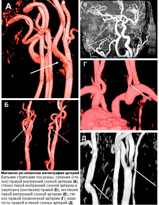 Магнитно-резонансная ангиография артерий. Белыми стрелками показаны: сужение (стеноз) правой внутренней сонной артерии (А); стеноз левой внутренней сонной артерии и закупорка (окклюзия) правой (Б); окклюзия левой внутренней сонной артерии (В); стеноз правой позвоночной артерии (Г); извитость правой и левой сонных артерий (Д). Изображение: «Наука и жизнь»