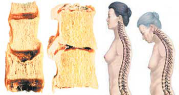 При остеопорозе тела позвонков грудного отдела не выдерживают нагрузки и постепенно принимают форму клиньев. В результате развивается кифоз (искривления позвоночника), уменьшается рост (изображение: «Наука и жизнь»)