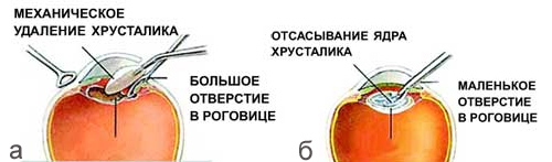 а — При традиционной хирургии катаракты мутный хрусталик удаляют механическим путем через разрез длиной 15 мм<br>б — При использовании новых высокотехнологичных методов мутный хрусталик дробят ультразвуком или вымывают струей жидкости через небольшой прокол длиной 3 мм (изображение: «Наука и жизнь»)