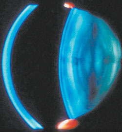 Продольный срез хрусталика больного катарактой. Снимок получен с помощью щелевой лампы (изображение: «Наука и жизнь»)