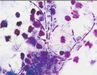 Кандиды (Candidus) —патогенные грибы. Изображение: «Наука и жизнь»