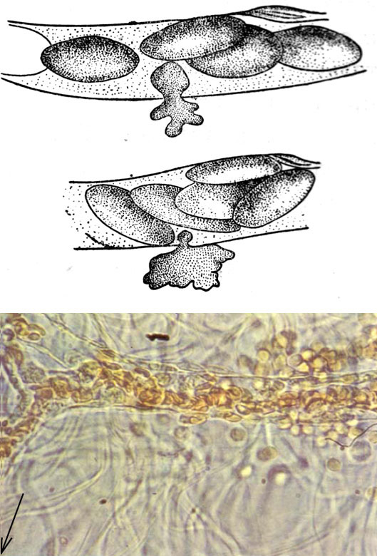Рисунок из лекции И. И. Мечникова о сравнительной патологии воспаления (1892): лейкоцит, проходящий сквозь стенку капилляра. Внизу — тот же процесс под световым микроскопом (лейкоциты, покинувшие венулу, показаны стрелкой). Изображение: «Химия и жизнь»