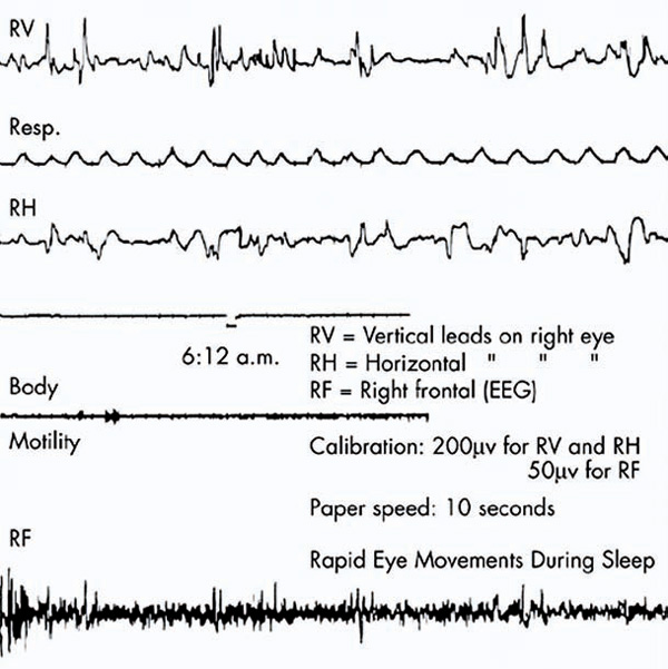 Иллюстрация из статьи 1953 года. Фрагмент записи в период быстрого движения глаз у спящего испытуемого (с сайта neuro.psychiatryonline.org)