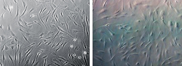 Отличия во внешнем виде прогениторных стволовых клеток жировой ткани у ребёнка 2,5 лет (<i>слева</i>) и у пожилого человека 61 года (<i>справа</i>) хорошо заметны