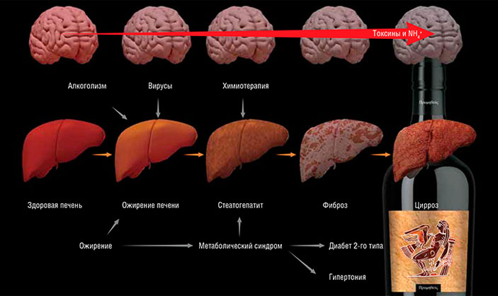 Сценарий развития патологических изменений, приводящих к печеночной энцефалопатии, может различаться («Наука из первых рук» №6(60), 2014)