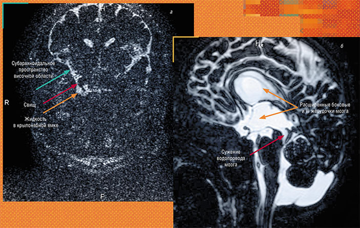 Cлева — свищ, дефект твердой мозговой оболочки. Справа — выраженное воронковидное сужение дистальных отделов водопровода мозга у ребенка с вентрикуломегалией («Наука из первых рук» № 3(88), 2020)
