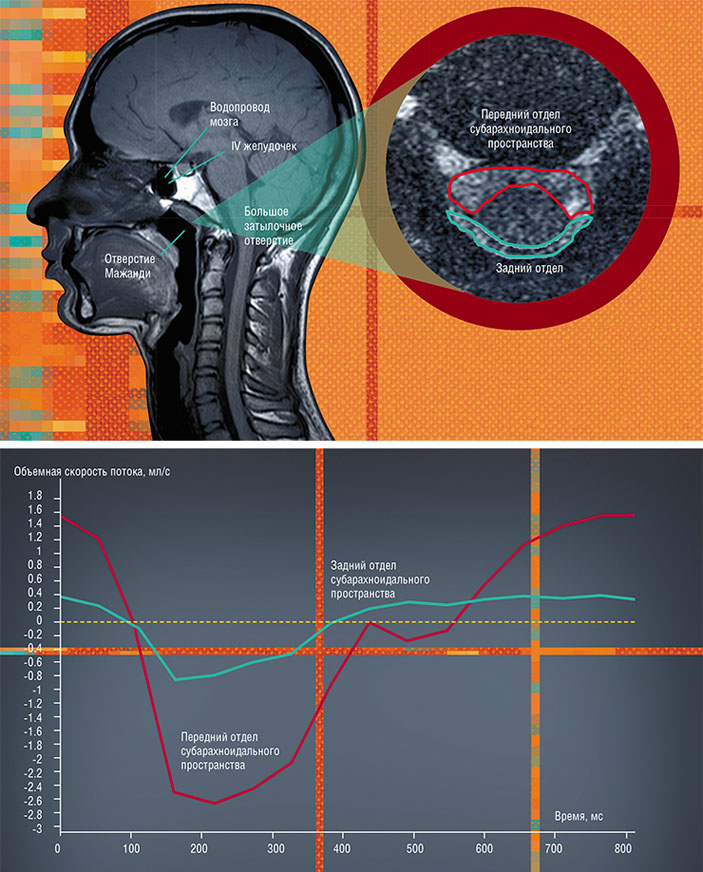 С помощью МРТ-методики количественной оценки потока (QF) можно провести многоуровневую качественную и количественную оценку параметров потока спинномозговой жидкости («Наука из первых рук» № 3(88), 2020)
