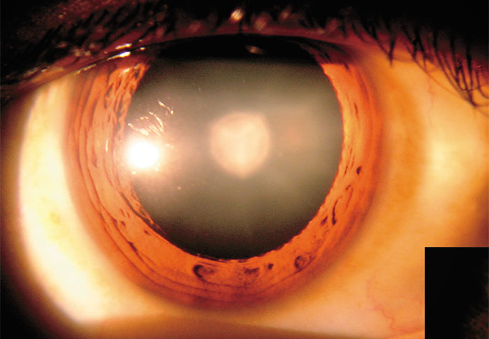 Катаракта («Наука из первых рук» №4(89), 2020)