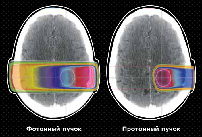 Сравнение пространственных дозных распределений фотонного и протонного пучков («Коммерсантъ Наука» № 9 (1), апрель 2021)