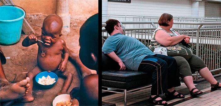 Вздутый живот у этого истощенного ребенка из лагеря нигерийских беженцев указывает на синдром Квашиоркор