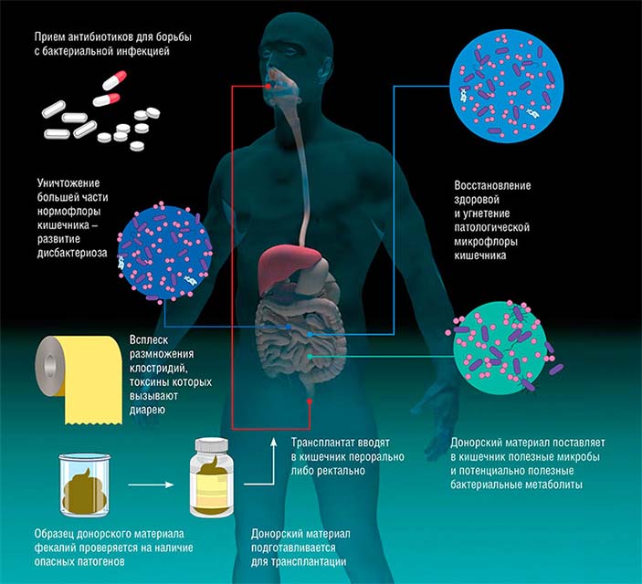 Этапы восстановления сбалансированной кишечной флоры после заражения клостридиями с помощью трансплантации фекального материала от доноров