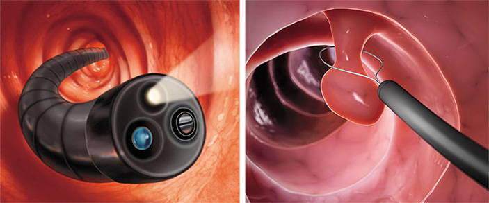 Колоноскопия