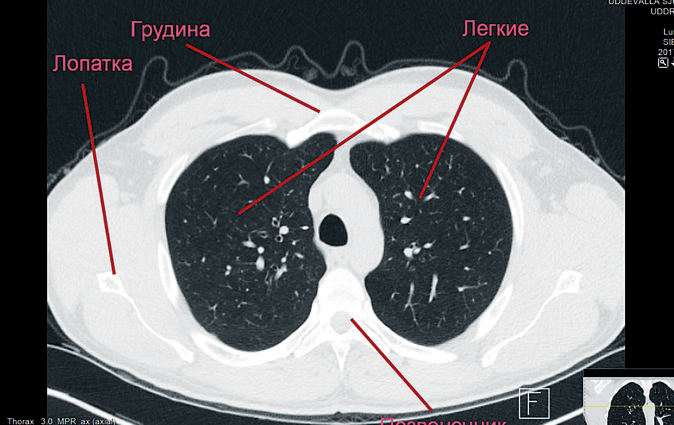 Одно из изображений при КТ лёгких