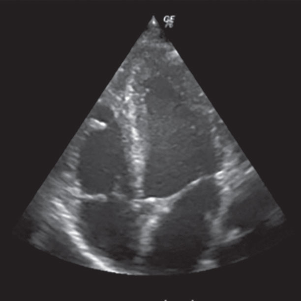 Сердце на УЗИ. Видны 4 камеры, перегородки и клапаны