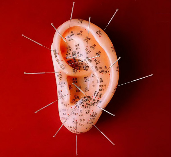 Акупунктура: лечит или калечит