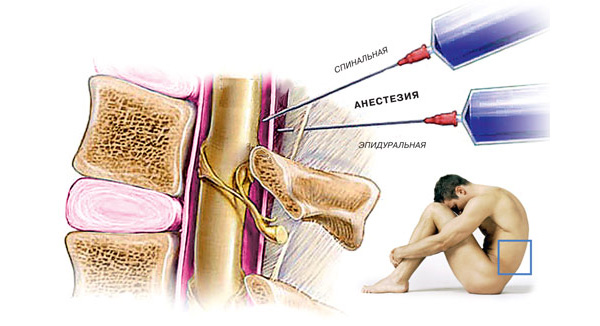 Сечение позвоночника, поясняющее идею нейроаксиальной анестезии и разницу между спинальной и эпидуральной анестезией