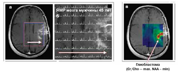 <b>Рис. 4.</b> Диагностика опухоли с помощью <sup>13</sup>С-ЯМР и <sup>13</sup>С-биомаркеров:<br>\n<b>а</b> — МРТ-снимок области мозга;<br>\n<b>б</b>—совокупность спектров <sup>13</sup>С-ЯМР <sup>13</sup>С-меченых креатина, холина и N-ацетиласпартата в обследованной области<i>. </i>В<i> </i>направлении стрелки сигналы креатин/холин растут, (Cr/Cho) N-ацетиласпартата (NAA) — падают;<br>\n<b>в</b> — изображение опухоли после математической обработки спектров